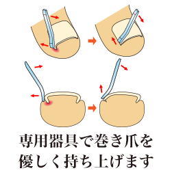 専用器具で巻き爪を優しく持ち上げます